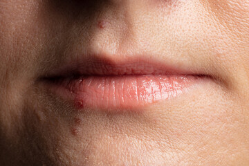 human lips close up with pimples on the face