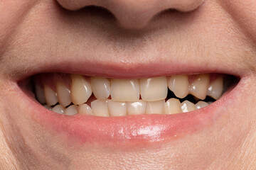 close-up smile with yellow teeth before whitening