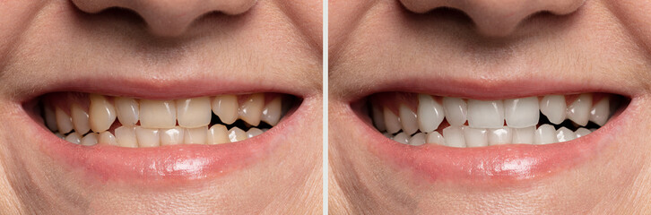 teeth whitening before and after close-up