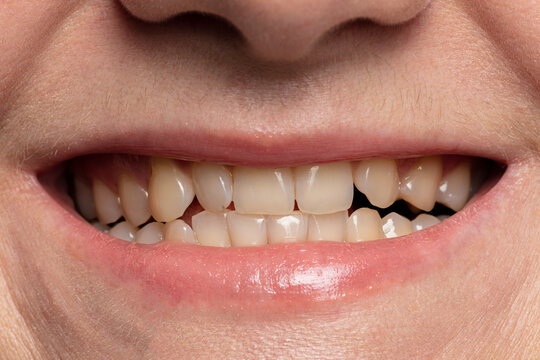 Close-up Smile With Yellow Teeth Before Whitening