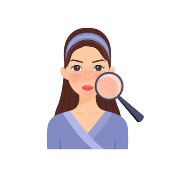 Rosacea. Couperose on Female Face. Dilated Capillaries and Beautiful Woman. Magnifying Glass and a Close Up of Problem Skin. Diagnosis. Cartoon style. Illustration for Beauty, Medical design. Vector.