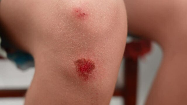 Close-up view 4k stock video footage of injured young kid's knee after he fell down on pavement. Wounded scraped red bleeding painful skin of leg