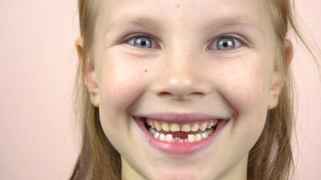 Close-up of the face of a little girl who shows her mouth with fallen milk teeth, grimaces.
