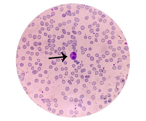 Human blood smear view in microscopy, complete blood count for treatment, eosinophil, magnification...