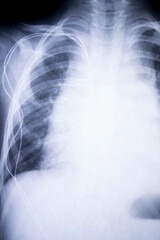 Plakat x-ray imagefrom the human chest and pacemaker