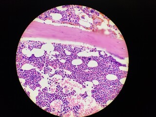 Bone marrow biopsy H and E stain showing eosinophilia