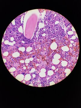Bone marrow biopsy H and E stain showing eosinophilia