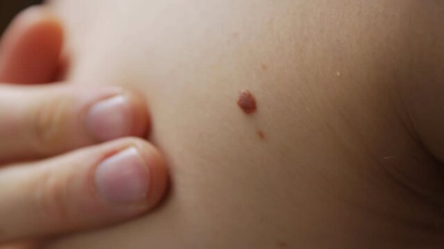 Moles on the body dermatology closeup