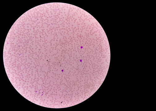 Abnormal microscopic view of hematological slide. Hemoglobin E (HbE) disease