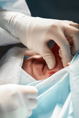 Close up of the face of a patient who is undergoing blepharoplasty. The surgeon cuts the eyelid and performs manipulations using medical instruments