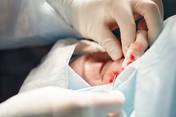 Close up of the face of a patient who is undergoing blepharoplasty. The surgeon cuts the eyelid and performs manipulations using medical instruments