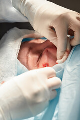 Fototapeta premium Close up of the face of a patient who is undergoing blepharoplasty. The surgeon cuts the eyelid and performs manipulations using medical instruments