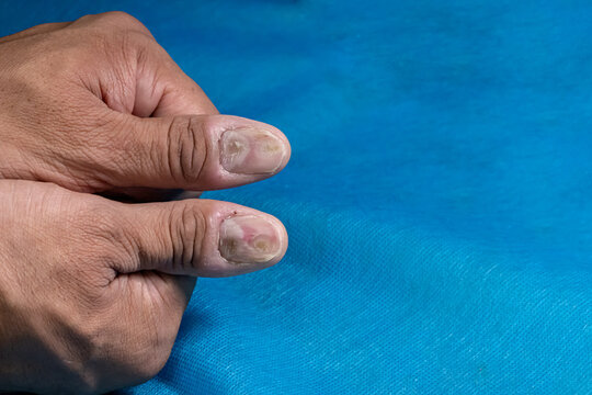 Males thumbs with fungal nail infection. Medical themes.