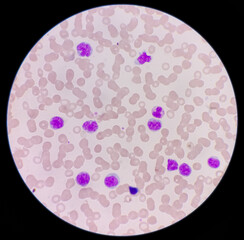 Microscopic image showing thrombocytopenia with leukocytosis, monocytes and myelocytes increased,...