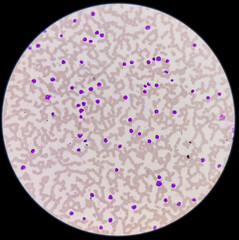 Microscopic image showing thrombocytopenia with leukocytosis, monocytes and myelocytes increased, myeloproliferative disorder.