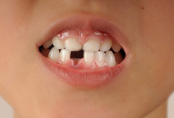 The baby's milk teeth and a hole in the bottom row. The first molar appears to replace the milk one. Close-up.