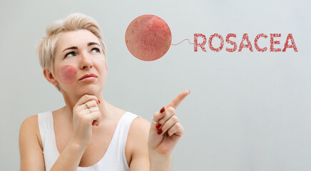 Portrait of an adult beautiful woman with couperose on her cheek. The woman thoughtfully points her...