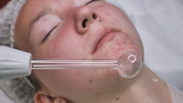 A beautician makes a darsonvalization of the face of a young girl with problem skin.