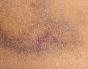 Fototapeta premium bruise on the skin as a background