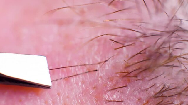 4K Super macro shot of hair removal with tweezers, on a caucasian person, at an extreme close up, in a studio.