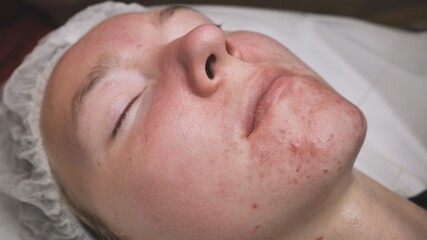 Naklejka premium A girl with problem skin of the face at the reception of a beautician.