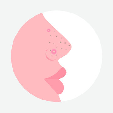 Blackheads and red pimples on the nose. Man's face in profile. Problem skin. Vector illustration, flat minimal cartoon design, isolated on white background, eps10.