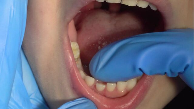 A doctor in blue gloves examines the child's mouth, the tooth is wobbling, followed by a new tooth.