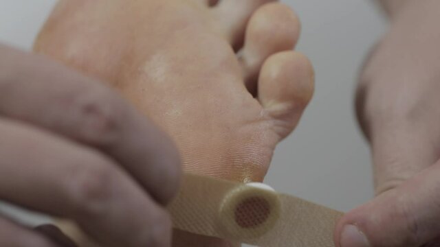 A man puts a medical patch on a plantar wart on his leg. Treatment plantar wart, macro