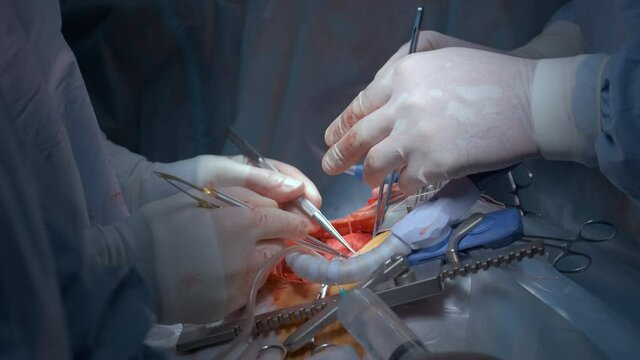 Closeup of professional doctor hands operating a patient during open heart surgery in surgical room. Healthcare and medical intervention concept.