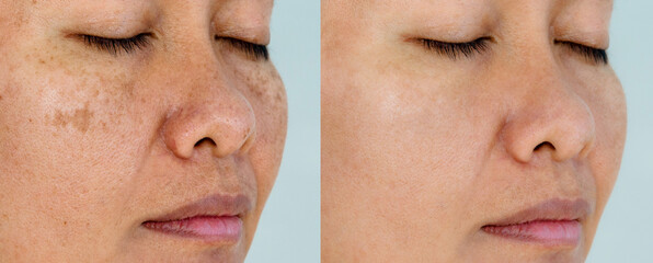 Image before and after spot melasma pigmentation facial treatment on asian woman face. skincare and health problem concept. 