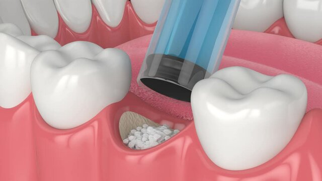 3d dental bone grafting and bone augmentation procedure