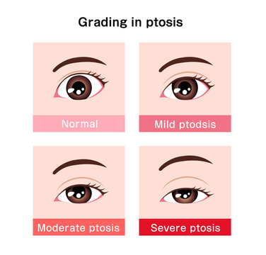 Grading In Ptosis Vector Illustration