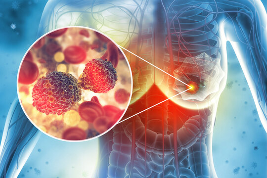 Breast cancer.Female breast anatomy