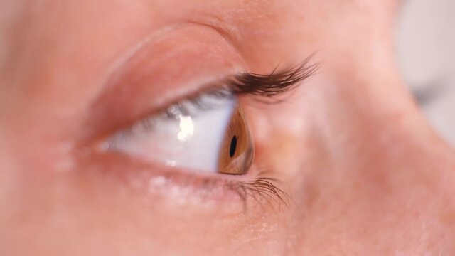 Eye of a patient with keratoconus, cornea in the form of a cone, severe degree of the disease.