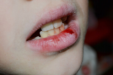 Dry and damaged lips of a girl. Close-up. Lip fissure and bleeding. Sick cracked damaged tissue....