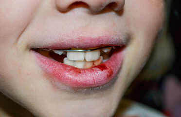 Dry and damaged lips of a girl. Close-up. Lip fissure and bleeding. Sick cracked damaged tissue....