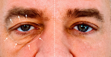 Compare man's eye before and after a blepharoplasty. Man aging problem eyes with wrinkle , big bag...