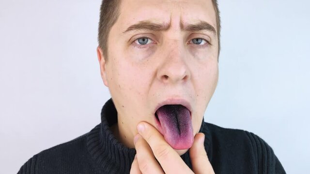 Close-up of a man black tongue. Clinical manifestations of lingua villosa. Bacterial infection of the mouth. The consequences of taking strong antibiotics. Fungal infection