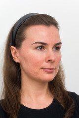 post-acne on the patient's face. Remission of papulopustular rosacea