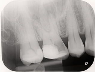 Xray of four human upper right teeth, the second molar has been heavily filled and part of the filling has cracked and is showing an infection, abscess. Root canal and crown required. Endodontist. - 472258342