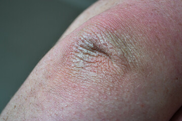 Close up dry flaky skin on elbow, caused by psoriasis. High quality photo