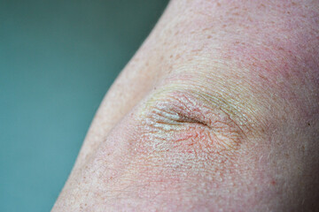 Fototapeta premium Close up dry flaky skin on elbow, caused by psoriasis. High quality photo