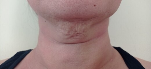 Fototapeta premium Under the chin of a woman has sagging skin.