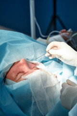 Close up of the face of a patient who is undergoing blepharoplasty. The surgeon cuts the eyelid and performs manipulations using medical instruments