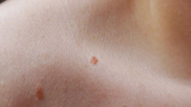 Birthmarks on the skin closeup