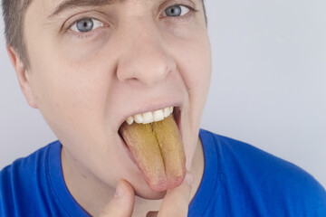 The man has a yellow tongue. Painful yellow coating on the mucous membrane of the tongue. Diseases...