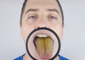 The man has a yellow tongue. Painful yellow coating on the mucous membrane of the tongue. Diseases...