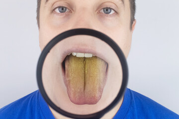 The man has a yellow tongue. Painful yellow coating on the mucous membrane of the tongue. Diseases...