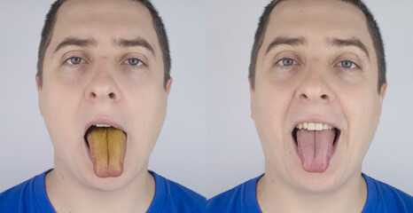 Before and after. Man has a yellow tongue. Painful yellow coating on mucous membrane of the tongue....