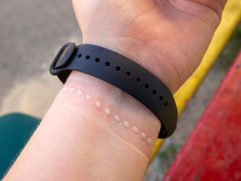 The mark on the hand from the watch strap. Rubbed damaged skin.